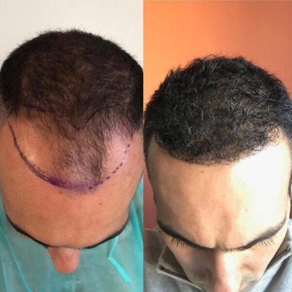 Hair Transplant – Natural & Permanent Solutions